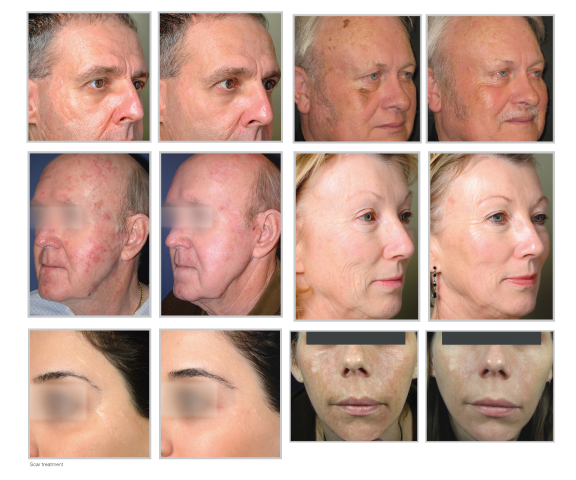 Fractional-Skin-Resurfacing-BA