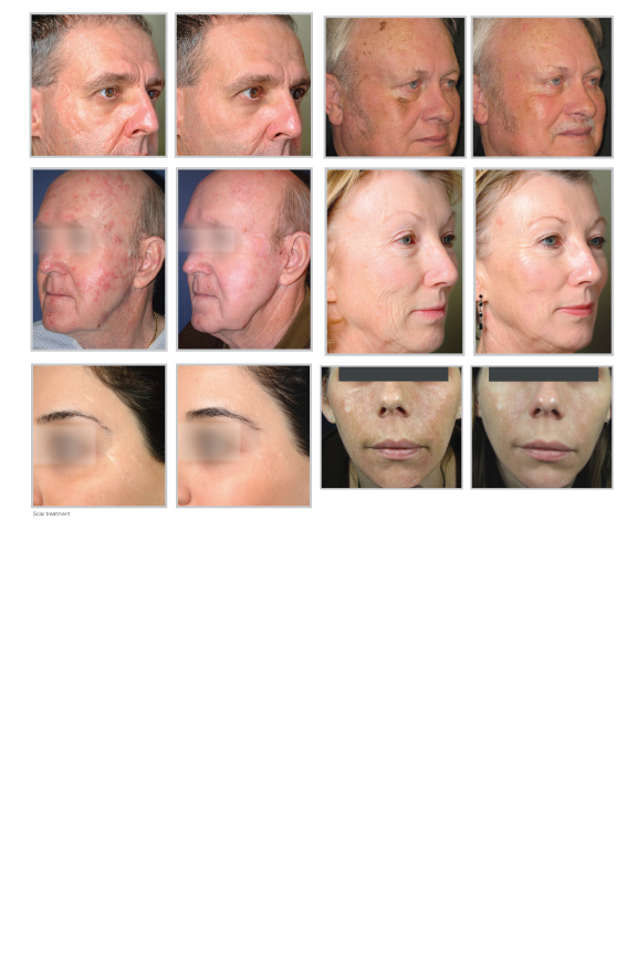 Fractional-Skin-Resurfacing-BA