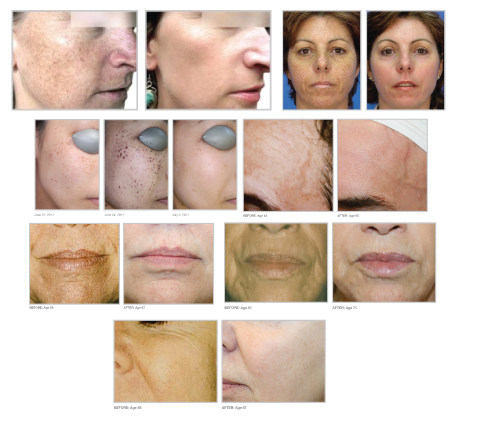 Photofacial-BA