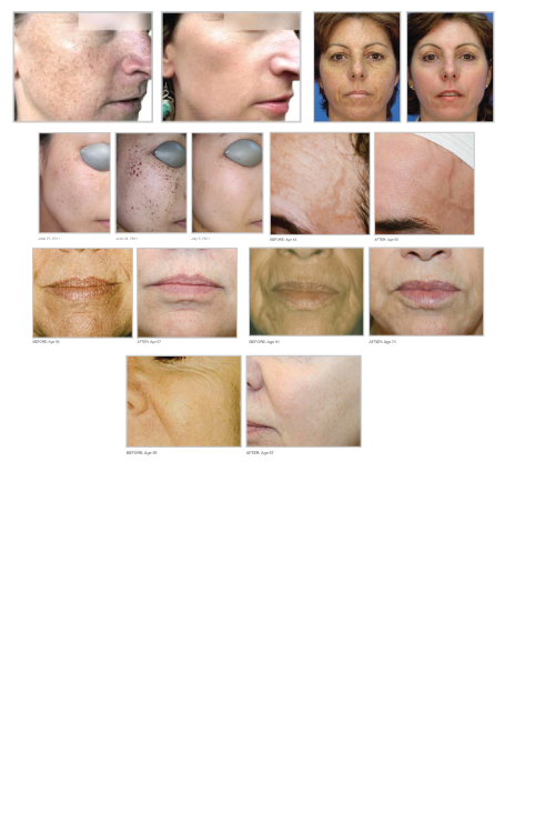 Photofacial-BA