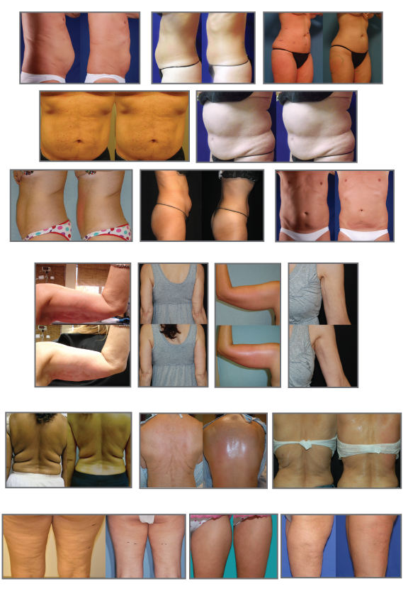 Vaser Shape Body Contouring - Renova Laser