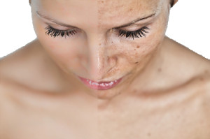 Melasma 