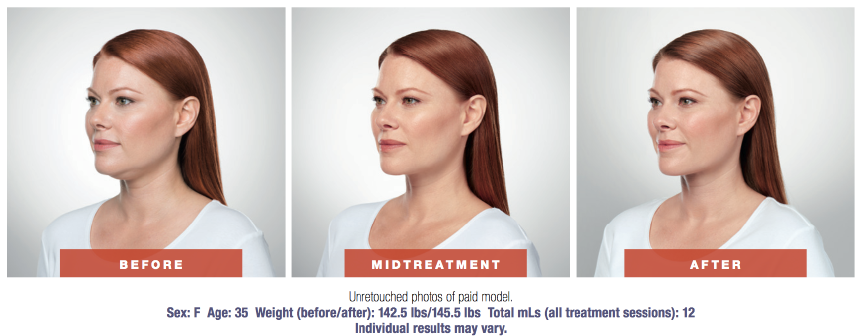 kybella before and after