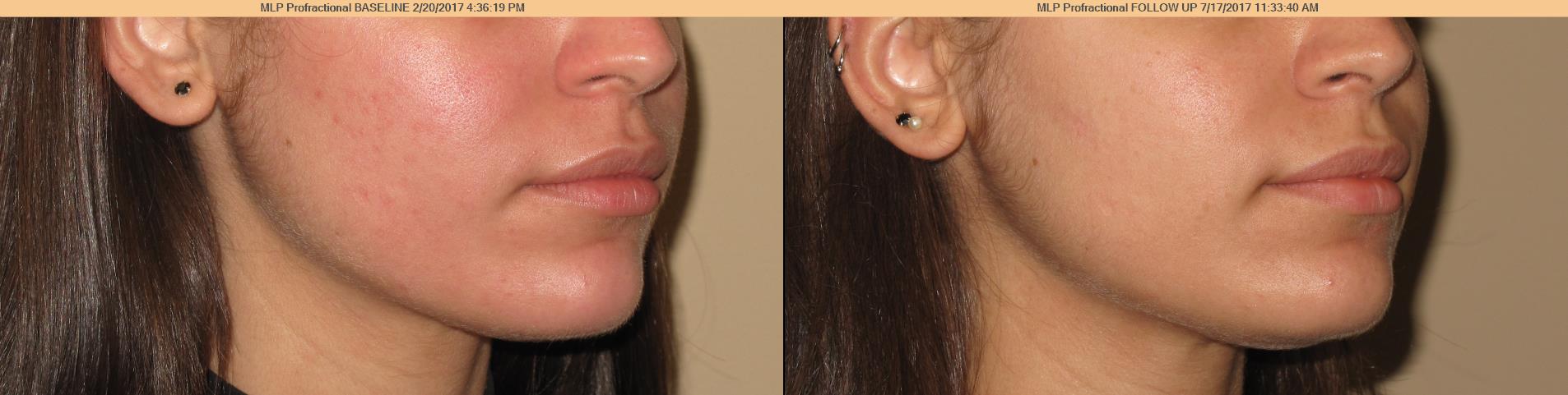 Micro needling before and after