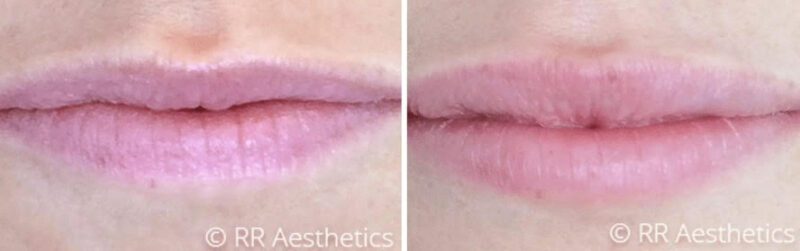 JUVEDERM VOBELLA before and after