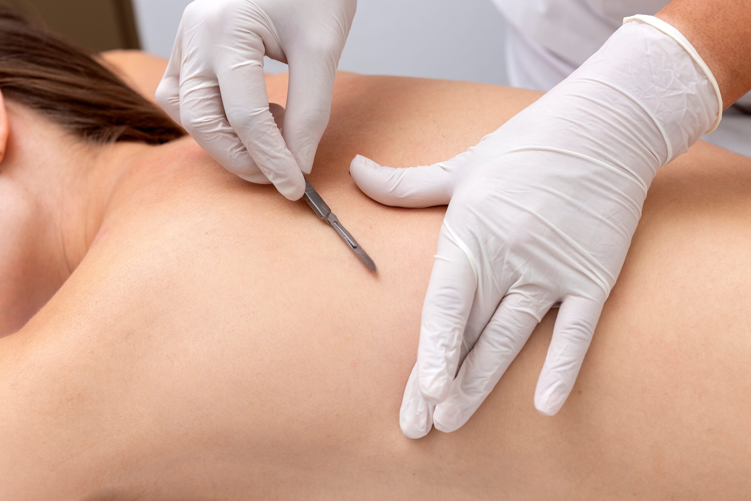 A doctor performing dermaplaning service on a shirtless patient's back