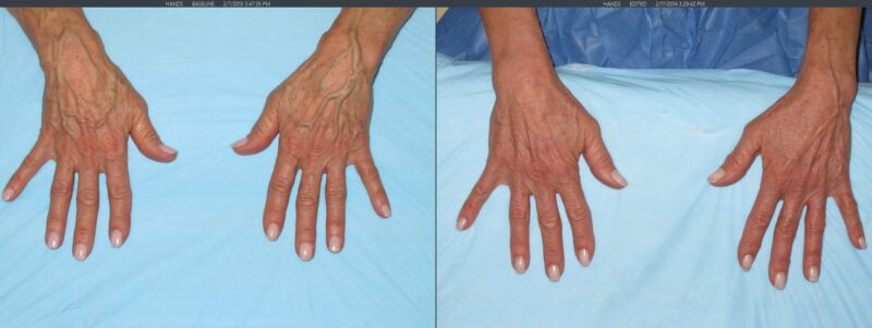 A before and after image, showing a hand with clearer skin and less veins after treatment